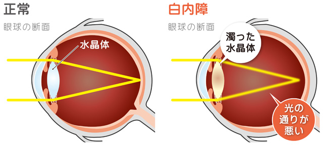 当院の日帰り白内障手術