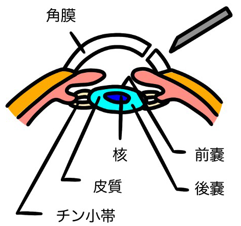 前嚢切開