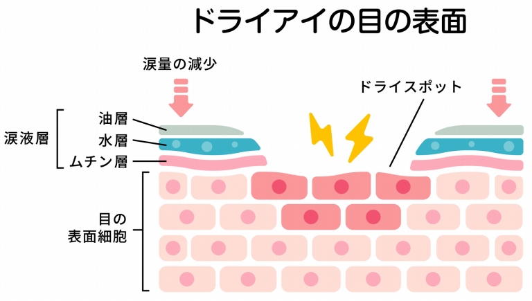 ドライアイとは