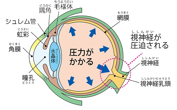 慢性緑内障