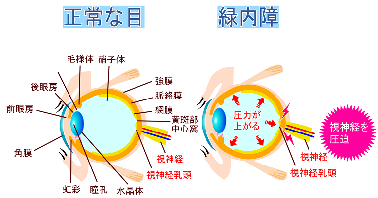 当院の日帰り緑内障手術