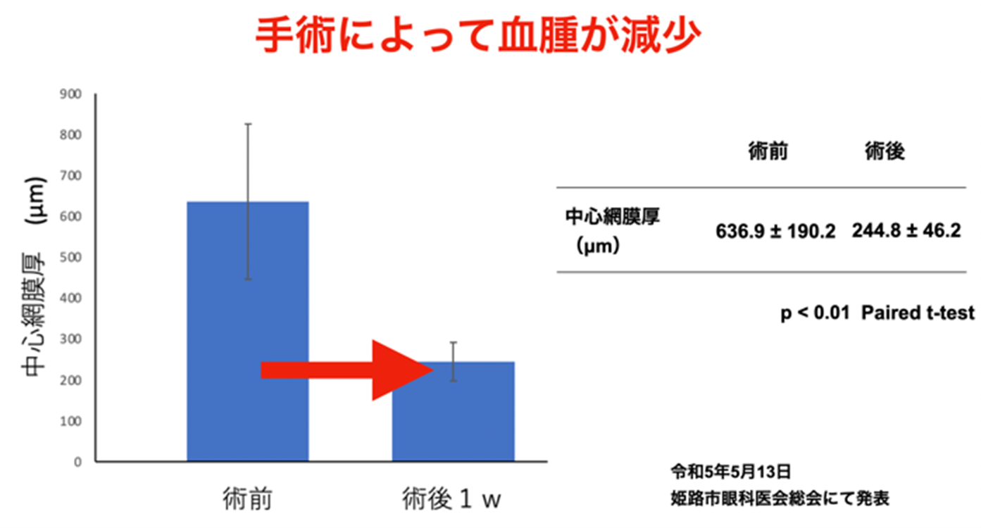 黄斑下血腫