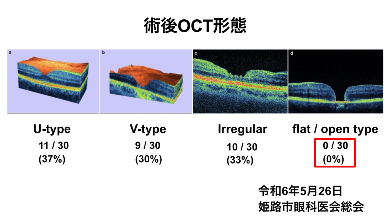 術後のOCT形態