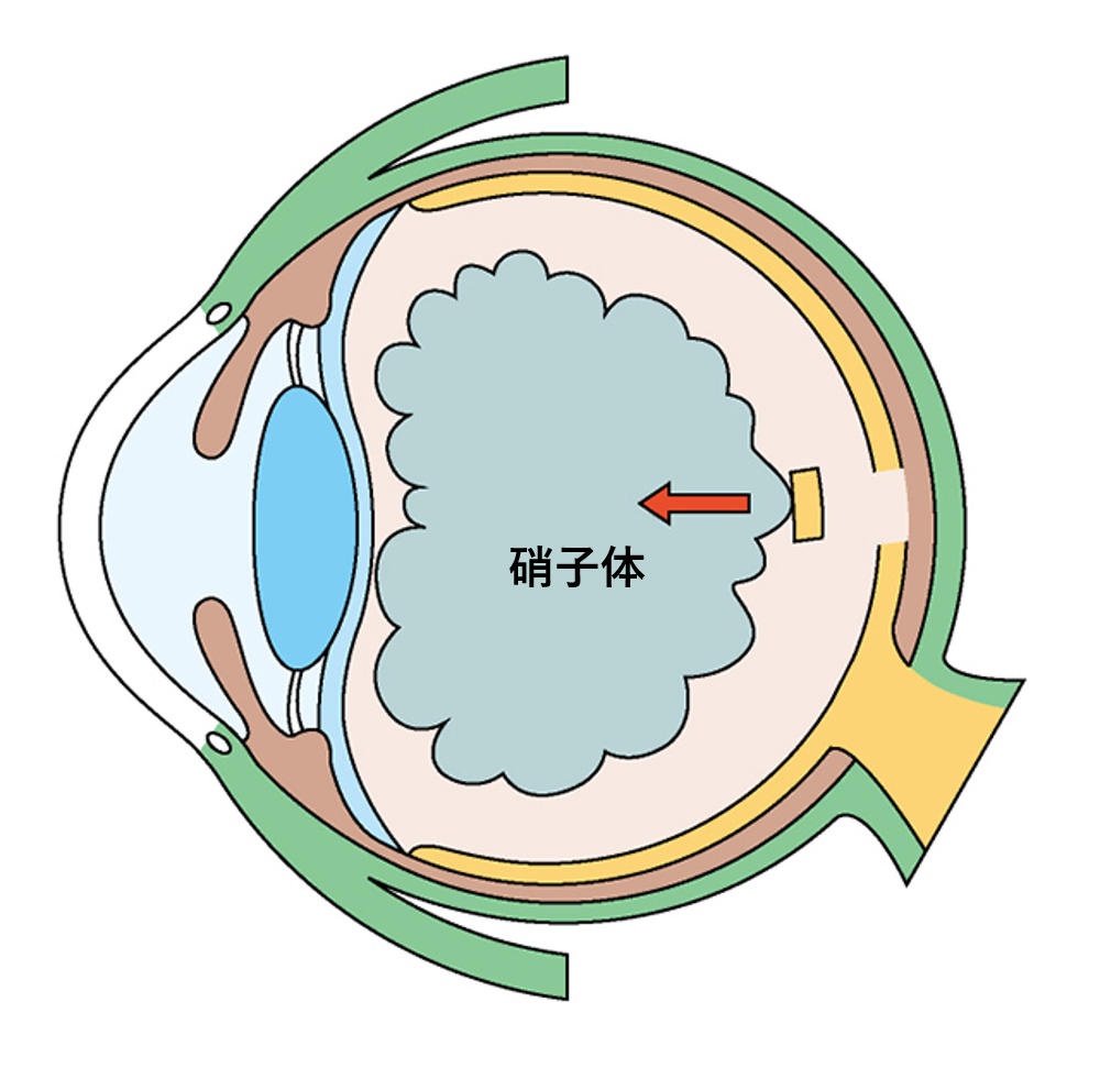 黄斑円孔の原因