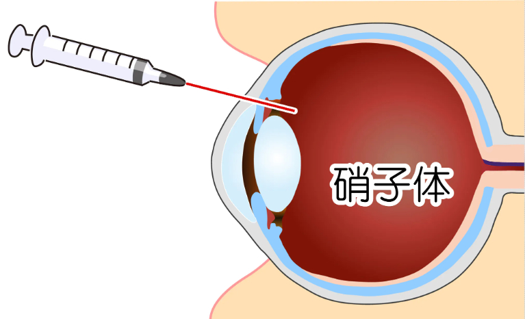 硝子体注射（抗VEGF療法）