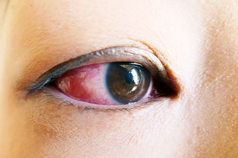 充血で目が痛いなど、このような症状でお悩みではありませんか？